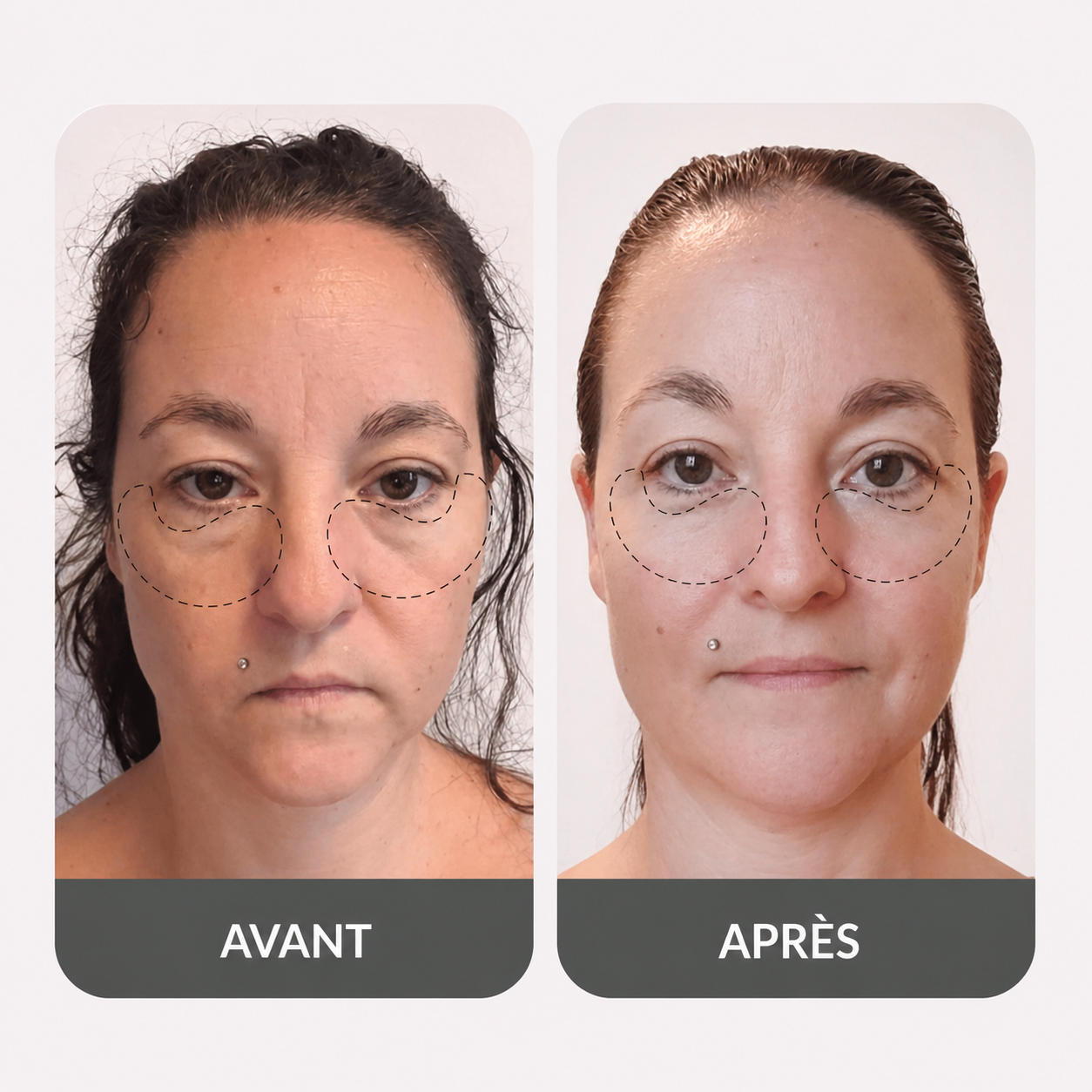 Lunettes Contour des Yeux LED & Micro-Courant